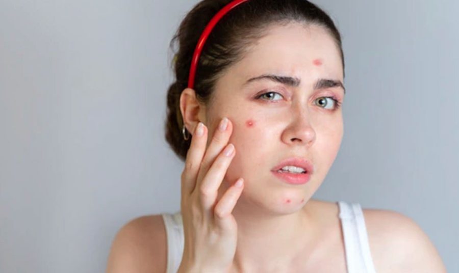 मुंहासों का इलाज अब घर पर, सिर्फ इन 3 चीजों से बनाएं असरदार फेस पैक