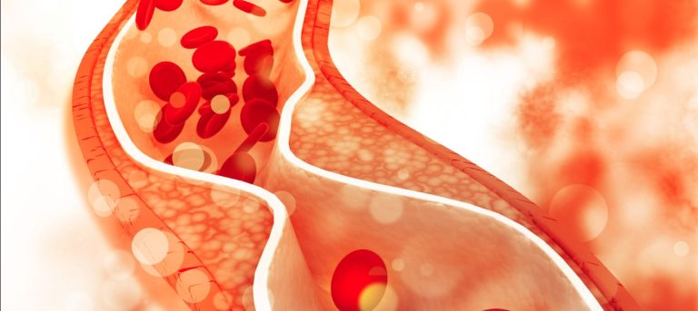 हाथ-पैर और आंखों के ये बदलाव बता सकते हैं बढ़ता कोलेस्ट्रॉल