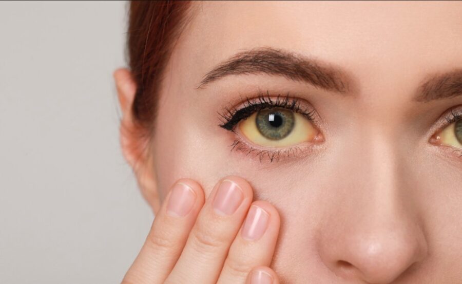 क्या है पीलिया, और यह कैसे विकसित होता है? आइये जानते हैं इसके लक्षण और कारण