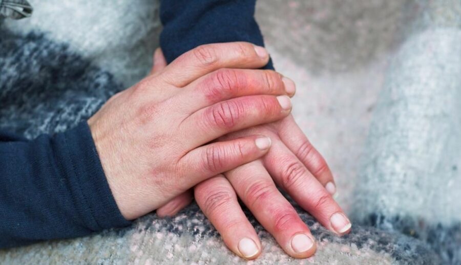 सर्दियों में क्यों होती है हाथ-पैर पर सूजन और जलन की समस्या? आइये जानते हैं इसके कारण